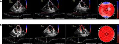 The alteration of left ventricular strain in later-onset spinal muscular atrophy children
